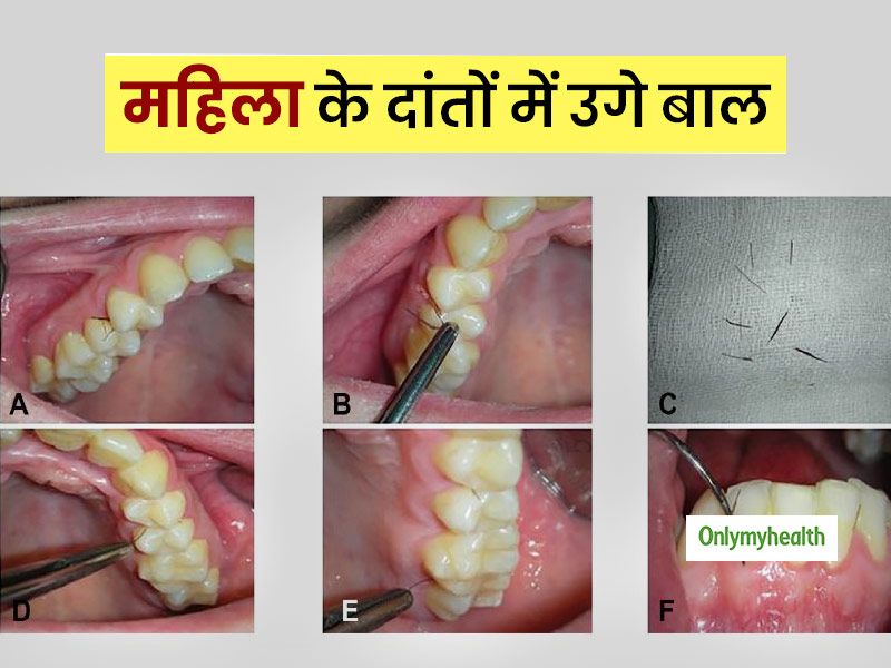 19 साल की लड़की के मसूड़ों में उगे बालों को डॉक्टरों ने सर्जरी से निकाला, 60 साल में छठा मामला